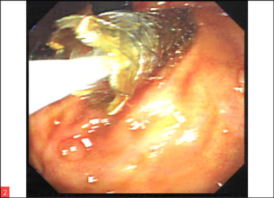 Endoscopic ultrasound guided hepaticogastrostomy (EUS HGS) Image 2